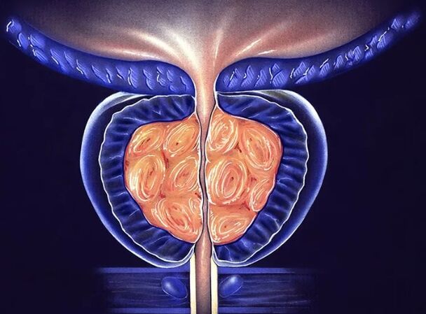 Chronische bacteriële prostatitis bij mannen