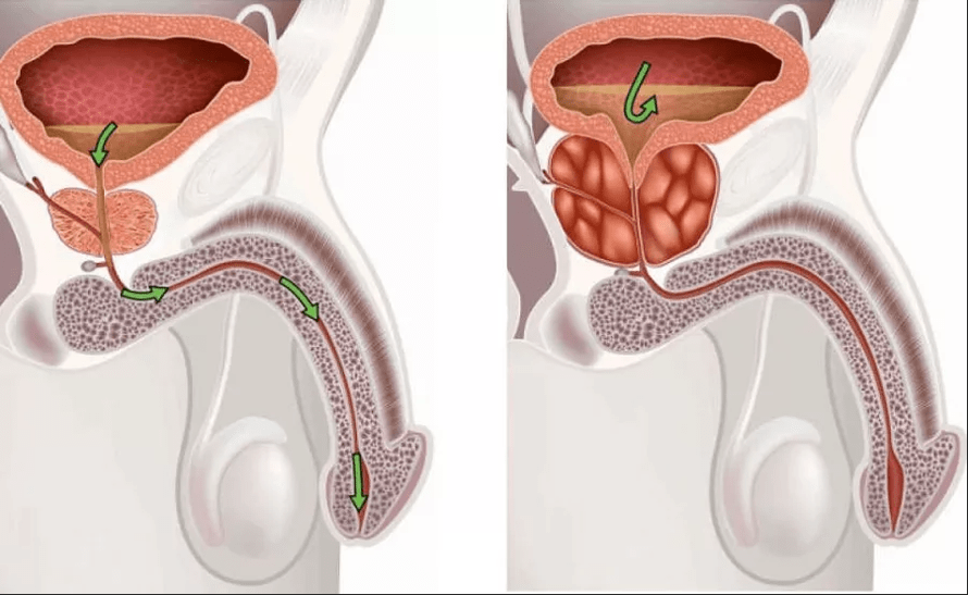 Symptomen van prostatitis